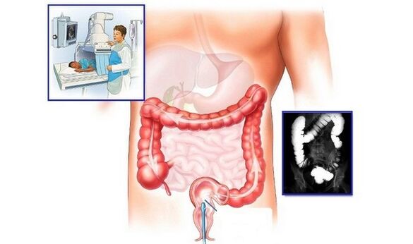 Radiografia intestinului gros cu contrast pentru diagnosticul hemoroizilor